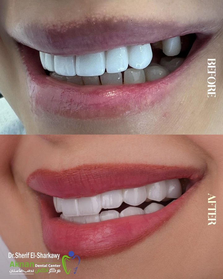 Before and after smile transformation 1