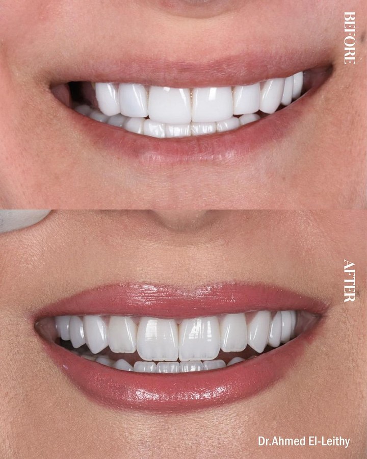 Before and after smile transformation 10