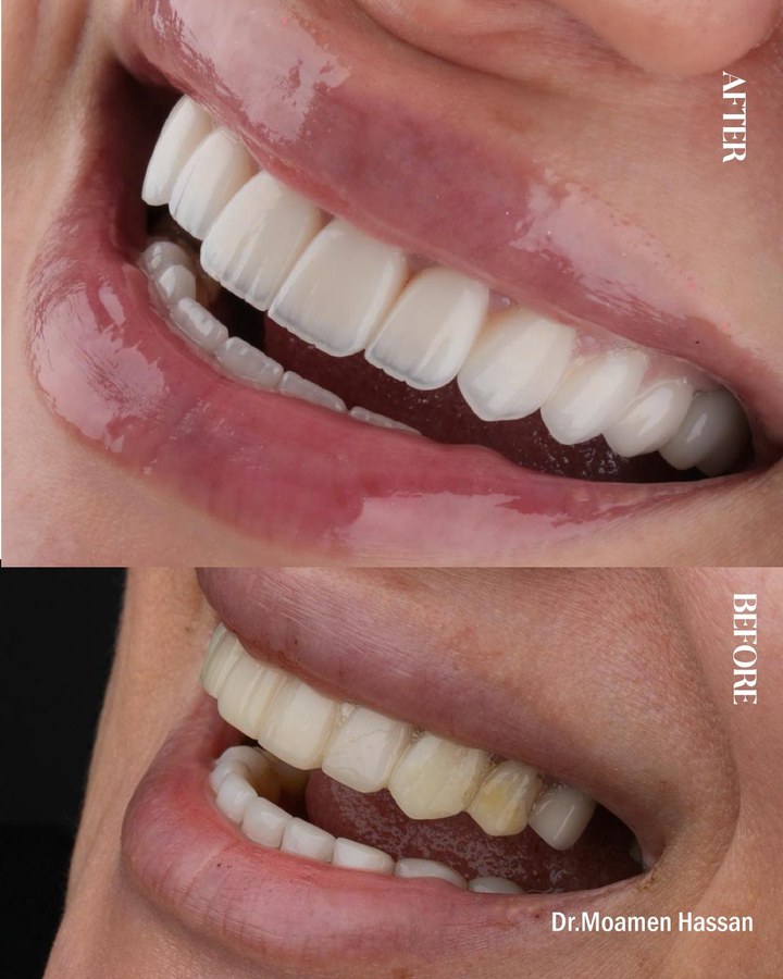Before and after smile transformation 11