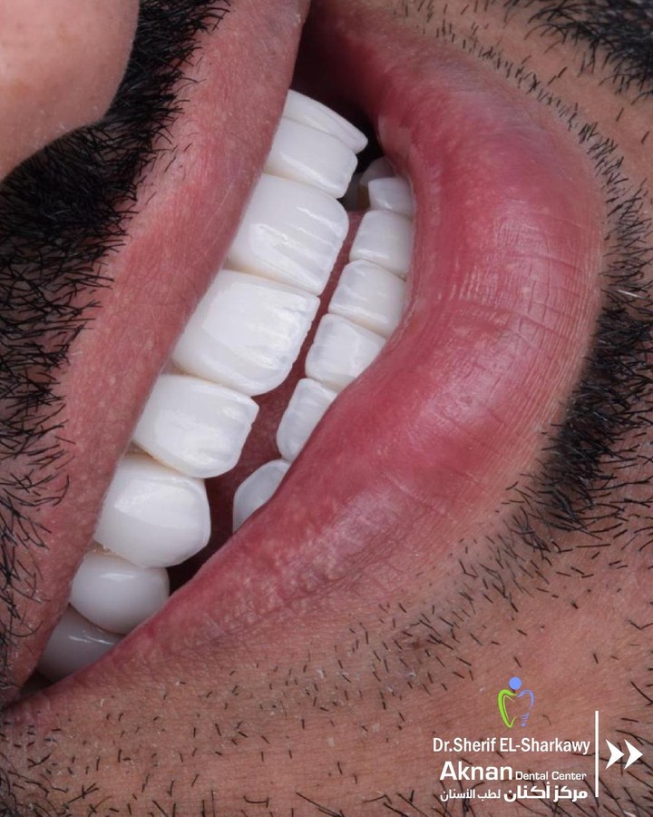 Before and after smile transformation 12