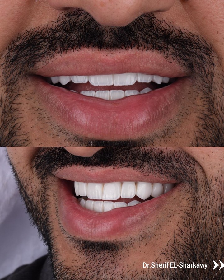Before and after smile transformation 13