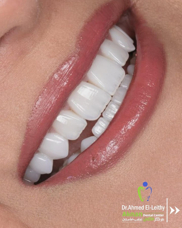 Before and after smile transformation 14