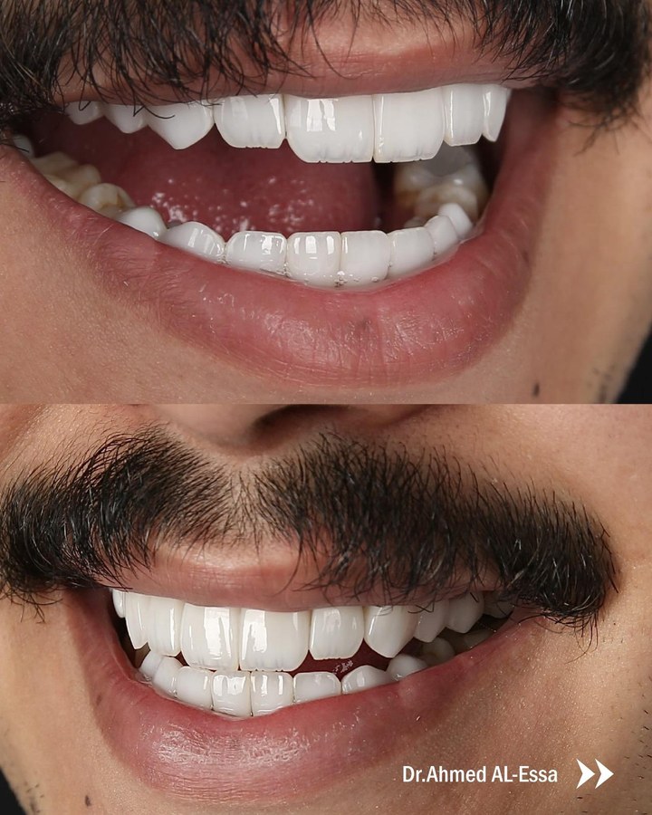 Before and after smile transformation 15