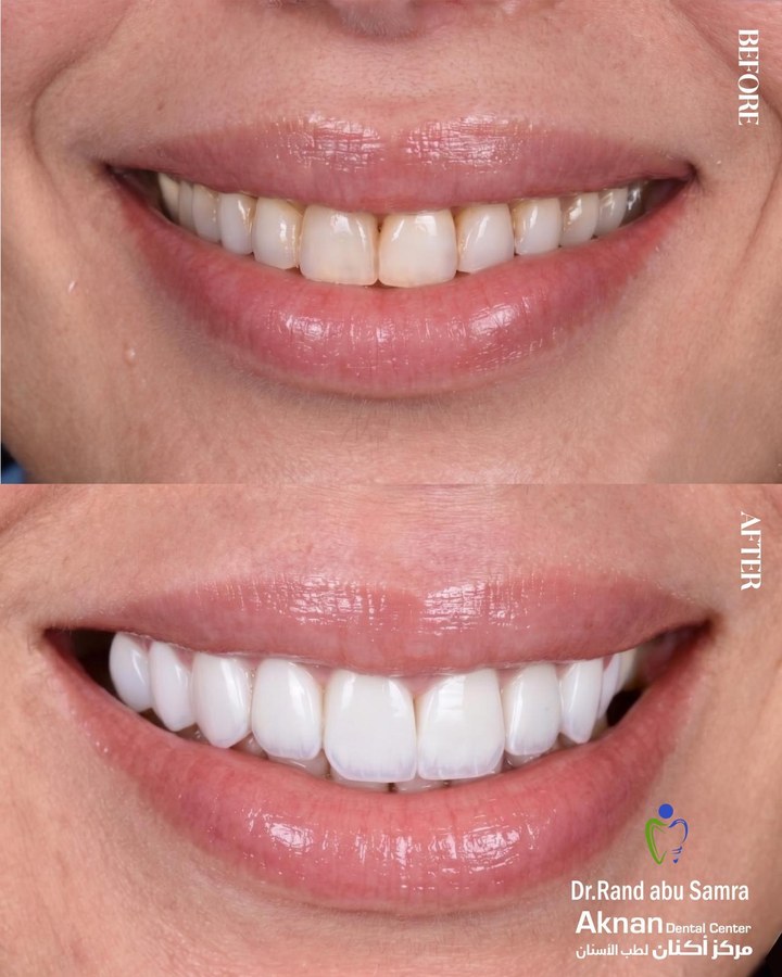 Before and after smile transformation 17