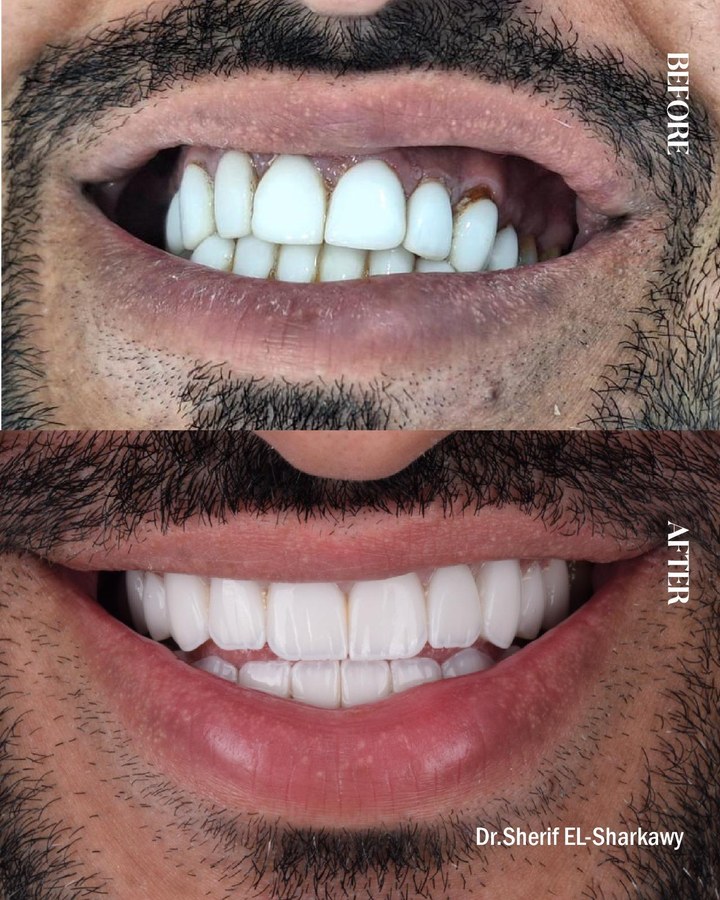 Before and after smile transformation 18