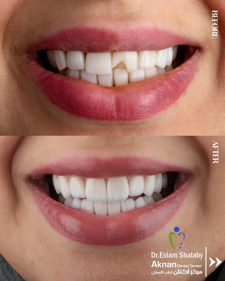 Before and after smile transformation 19