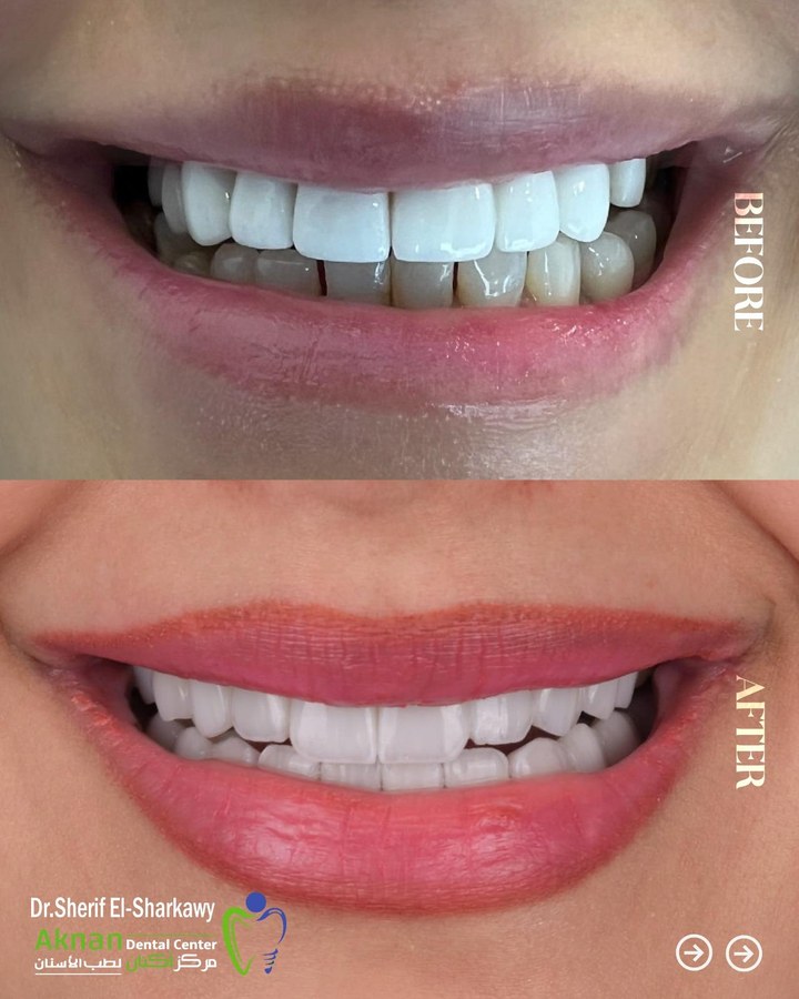 Before and after smile transformation 2