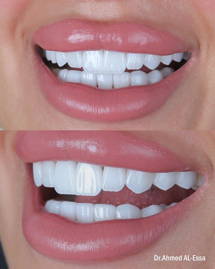 Before and after smile transformation 20