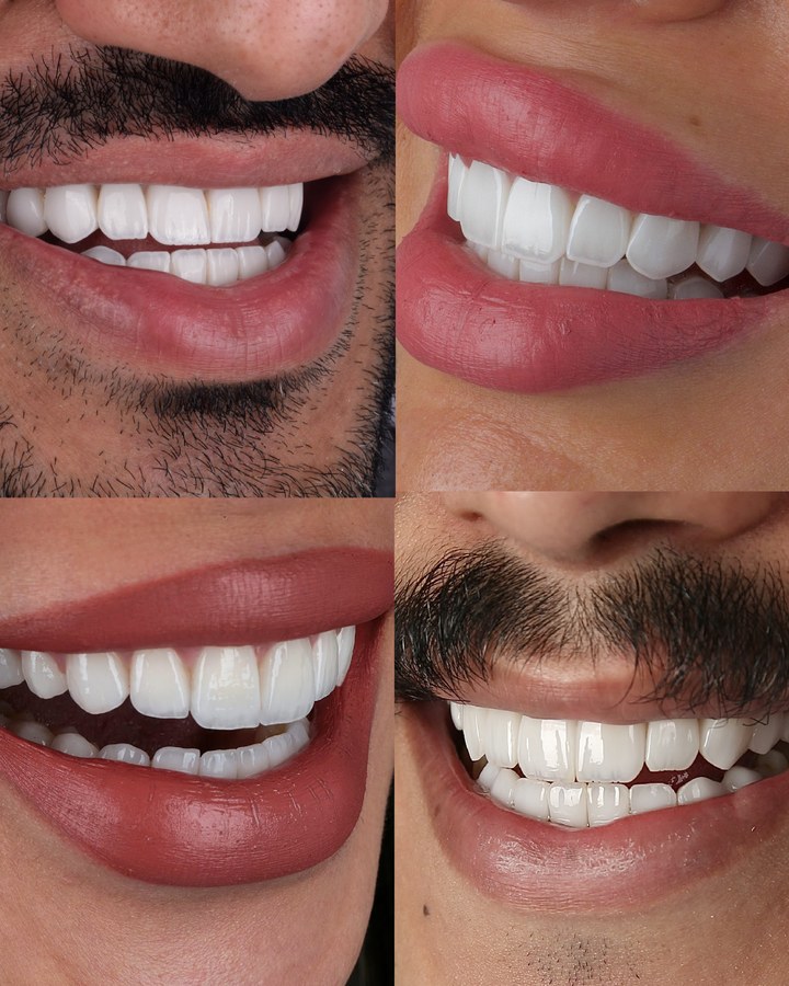 Before and after smile transformation 23