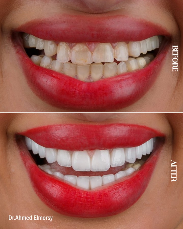 Before and after smile transformation 24