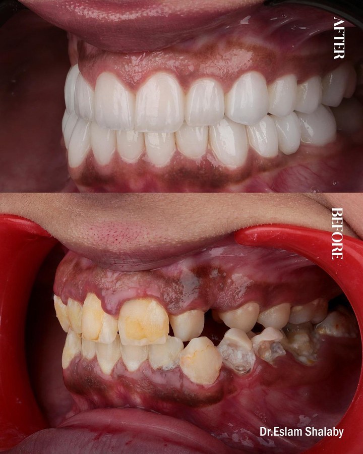 Before and after smile transformation 3