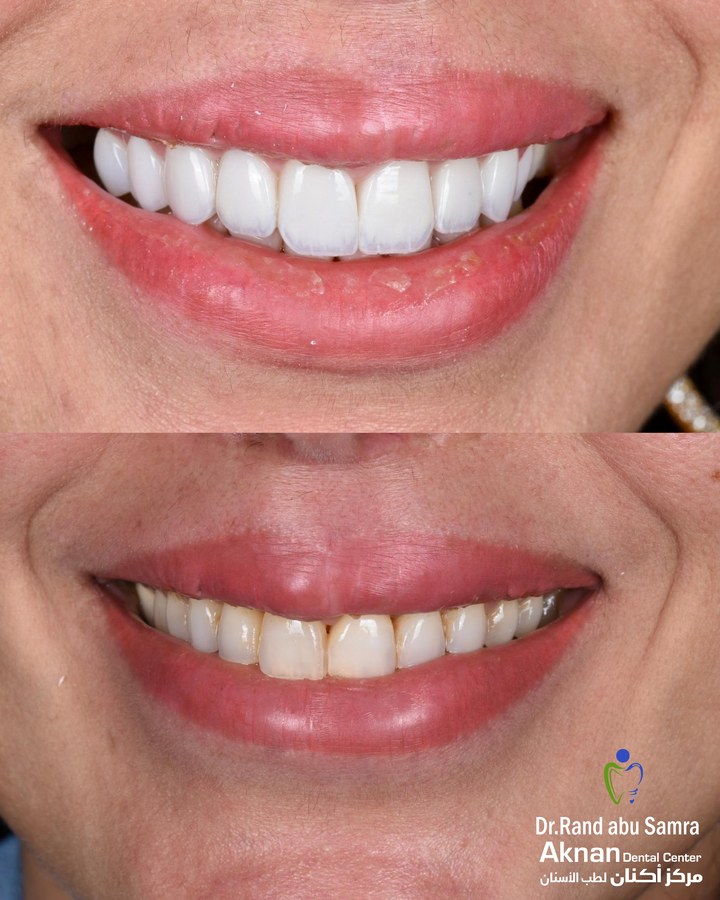 Before and after smile transformation 30