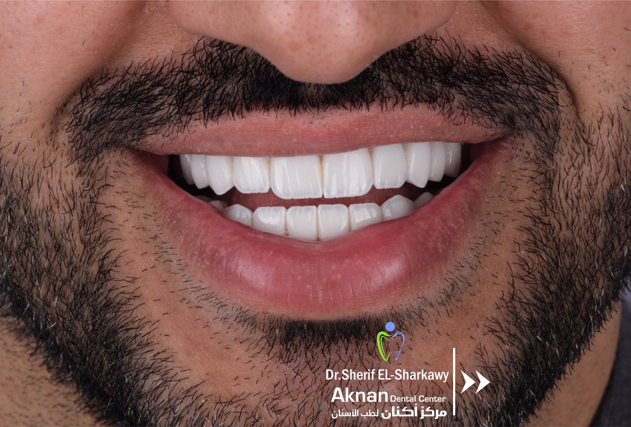 Before and after smile transformation 31