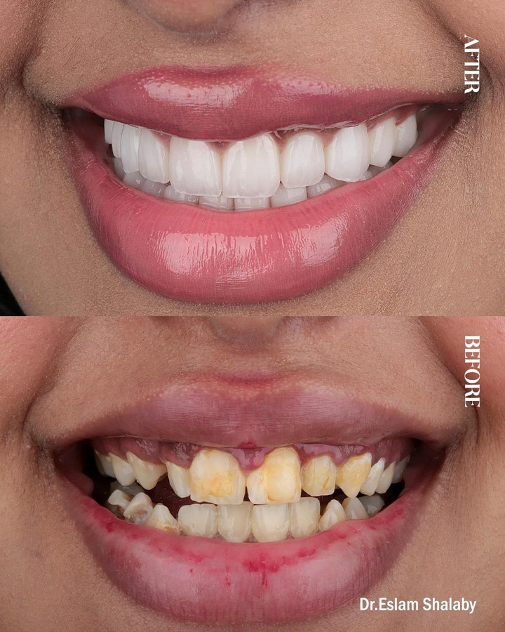 Before and after smile transformation 4