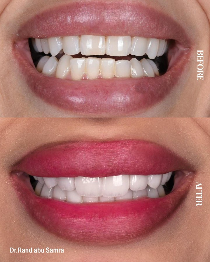 Before and after smile transformation 5