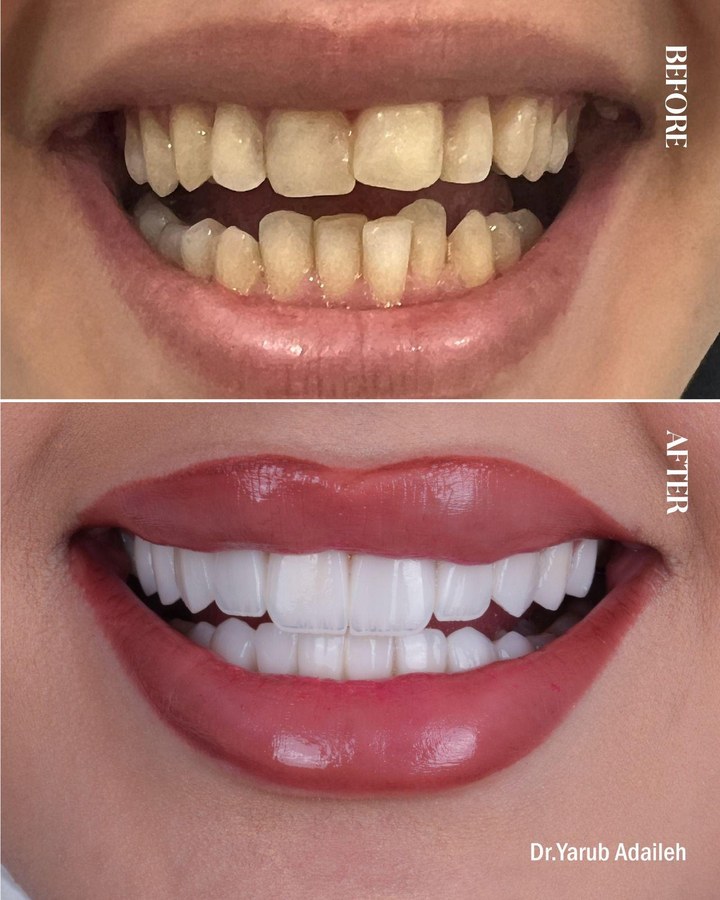 Before and after smile transformation 6