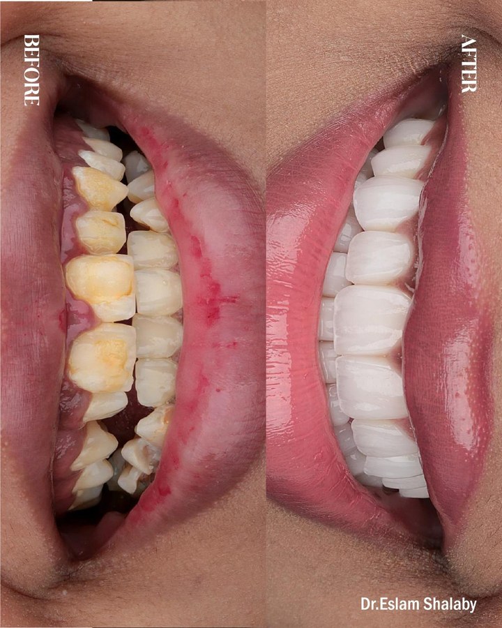 Before and after smile transformation 9