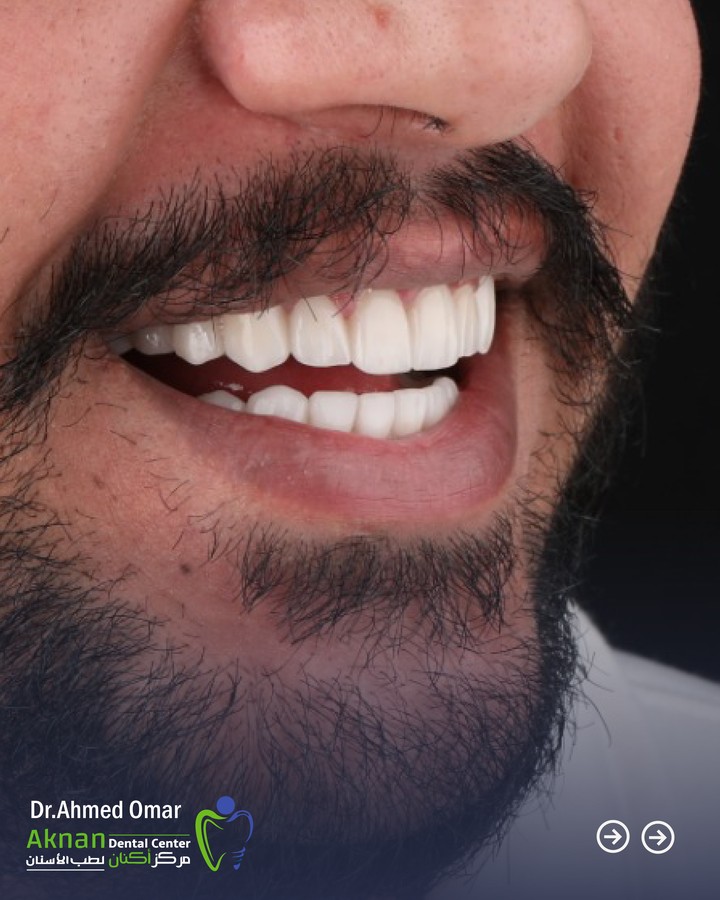 Smile transformation case by Dr Ahmed Omar