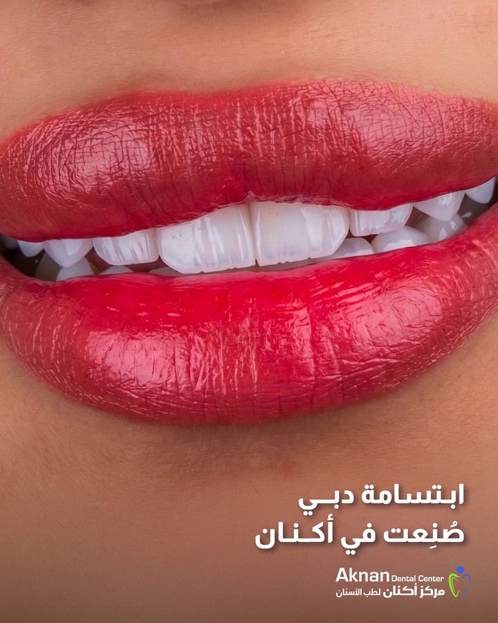 Dubai smile created at Aknan Dental